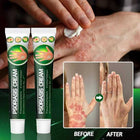 Psoriasis Cream - Herbal Plant Extracts 4